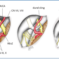 Microvascular flaps neck reconstruction