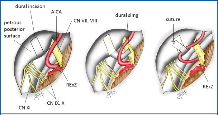 Microvascular flaps neck reconstruction