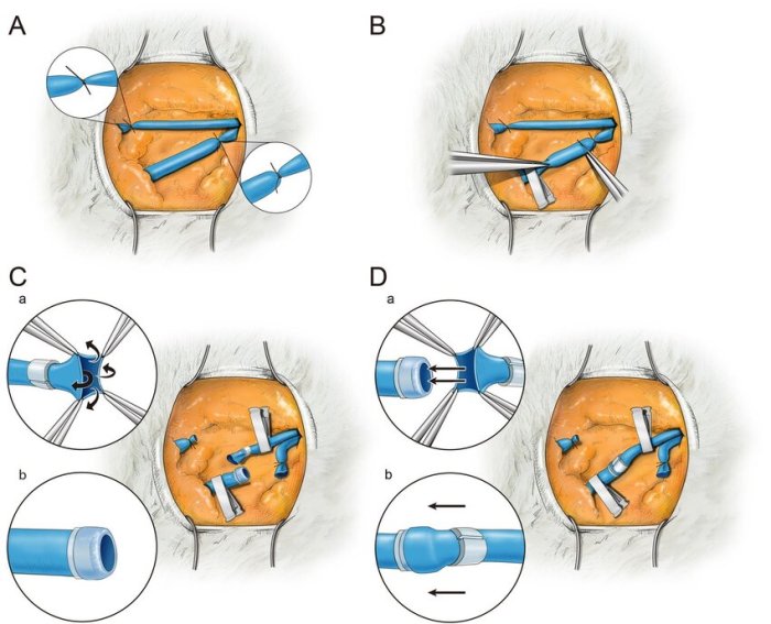 Free omental flap with microvascular anastomosis