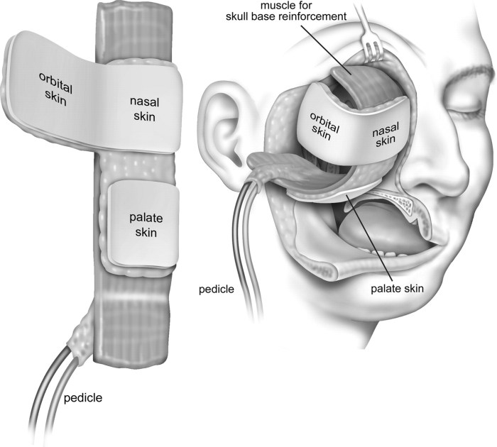 Free omental flap with microvascular anastomosis